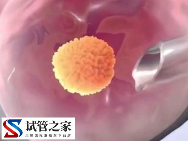 去台湾送子鸟做试管供卵要什么手续？